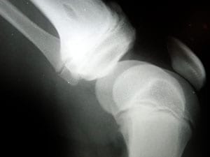 osteoarthritis of the knee