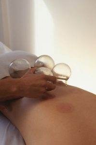 cupping