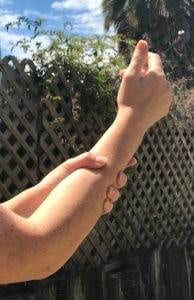 neuropathy carpal tunnel syndrome