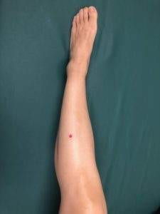 Stomach 37 acupressure point