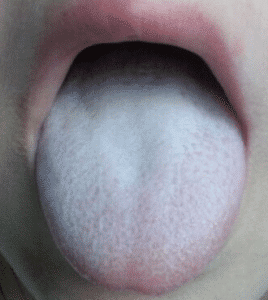 coated tongue