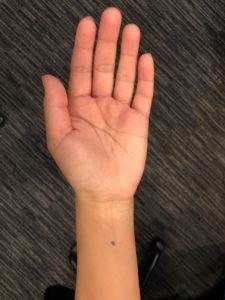 acupressure point PC-6 for nausea morning sickness
