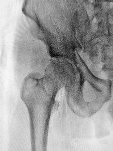 hip joint ball and socket joint