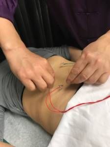 electroacupuncture