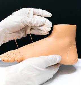 acupuncture points for Morton
