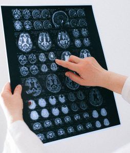 encephalitis brain inflammation