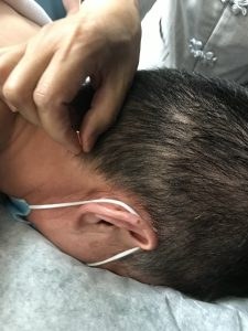 scalp acupuncture aphasia