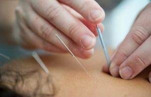 acupuncture treatment