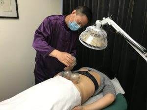 Cupping treatment