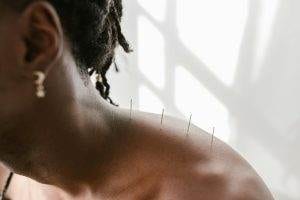 myofascial pain syndrome acupuncture 