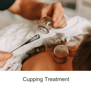 cupping treatment