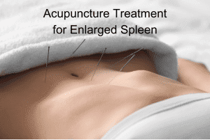 acupuncture for enlarged spleen
