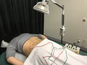 Woman with acupuncture needles and electroacupuncture wires hooked up
