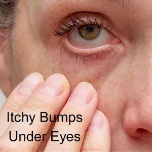 itchy red bumps under eyes periorbital dermatits