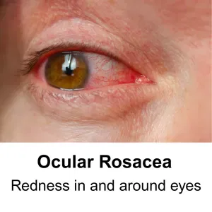 ocular rosacea - redness around eyes, bloodshot eyes