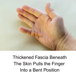 Bent finger Dupuytren's Contracture