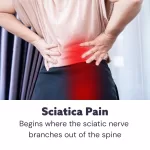 Acupuncture for Sciatica Pain