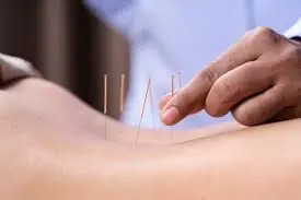 acupuncture treatment