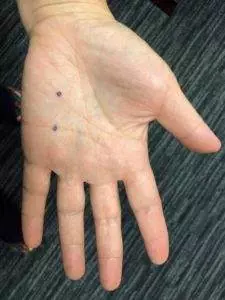 acupressure point for menstrual cramps