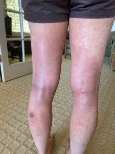 hives