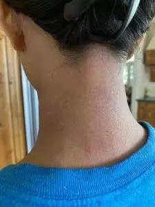 skin rash dermatitis eczema neck