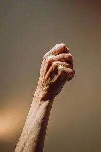 scleroderma hands