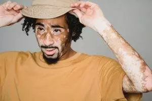 vitiligo white patches skin