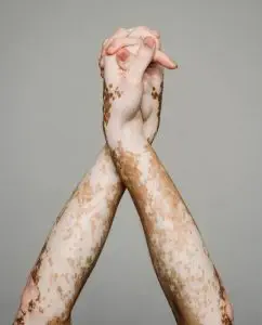 vitiligo