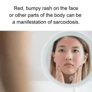 red bumpy rash on face 