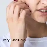 How to Treat Perioral Dermatitis With Acupuncture and TCM