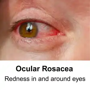 ocular rosacea - redness around eyes, bloodshot eyes