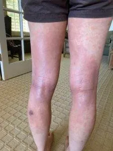 hives