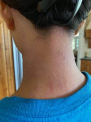 hives allergies