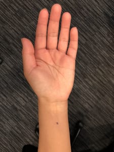 acupressure point PC-6 for nausea morning sickness