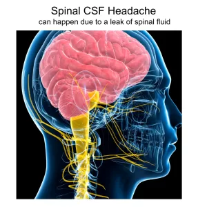 A CSF fluid leak is usually the cause of a spinal headache