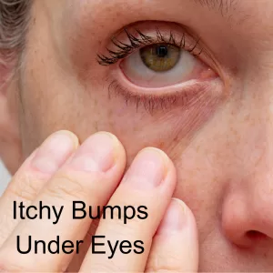 itchy red bumps under eyes periorbital dermatits
