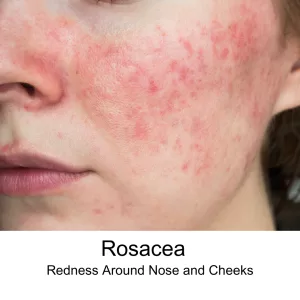 Red dot on face rosacea