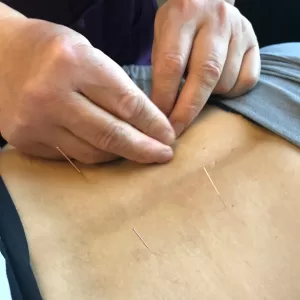 Acupuncture treatment for sciatic pain